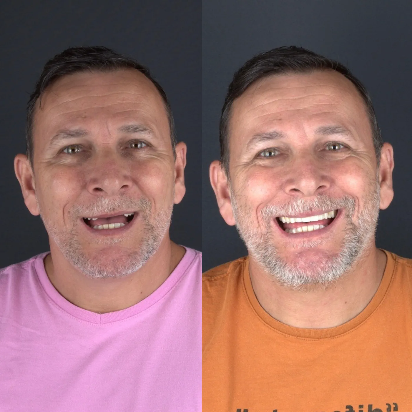 Antes e depois — All-on-4 inferior