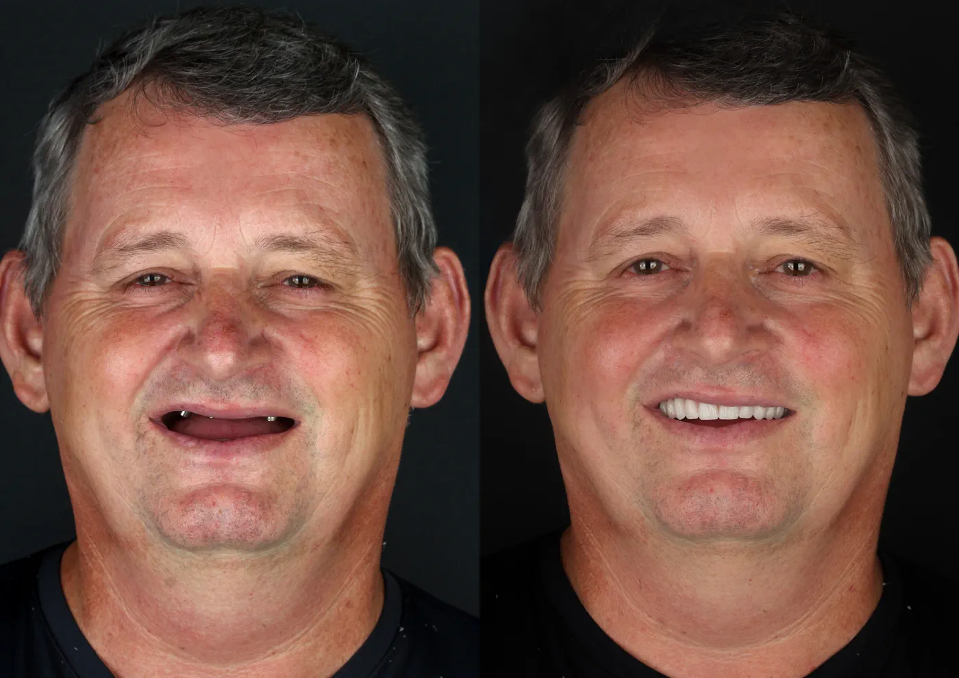 Antes e depois — protocolo All-on-4