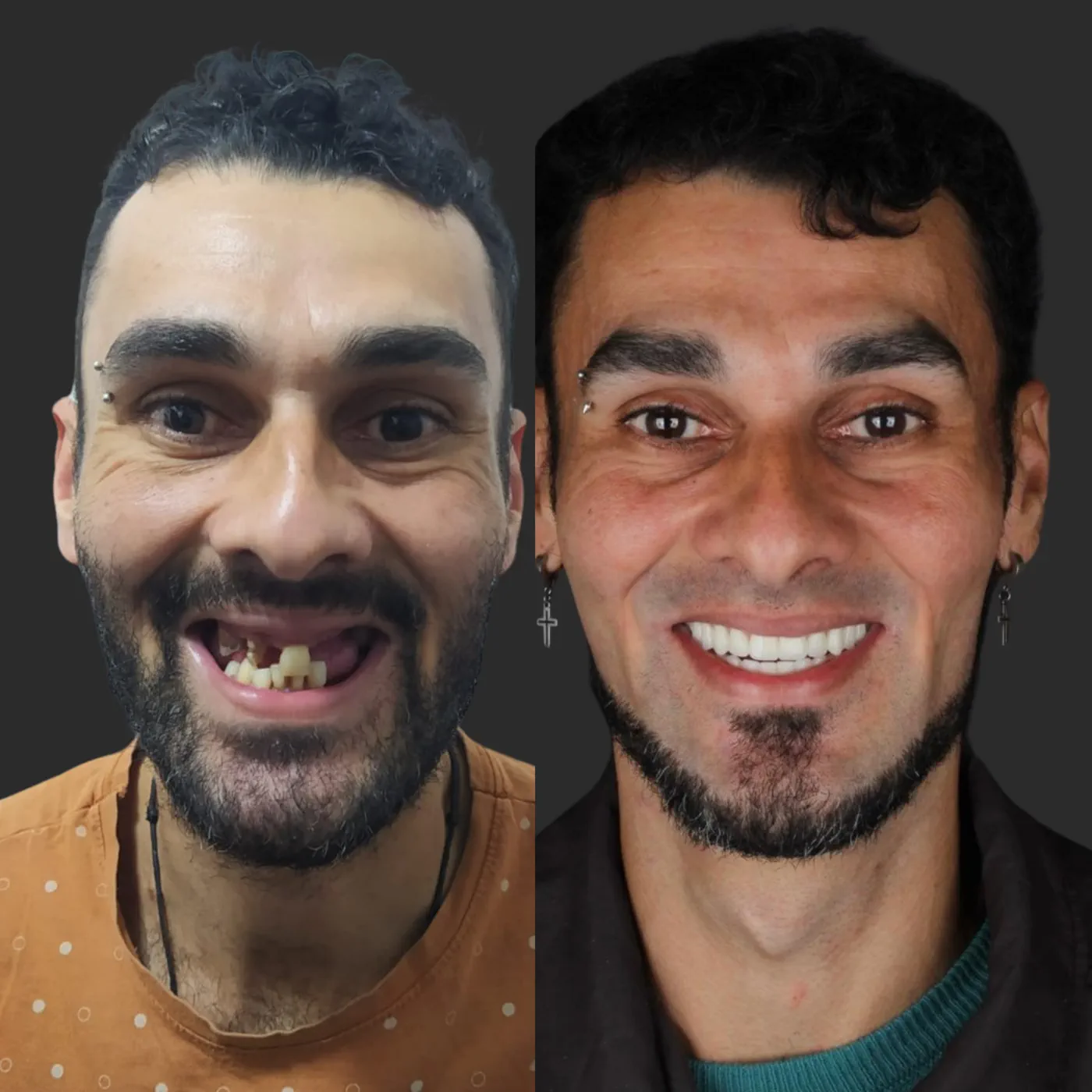 Antes e depois — All-on-6 completo