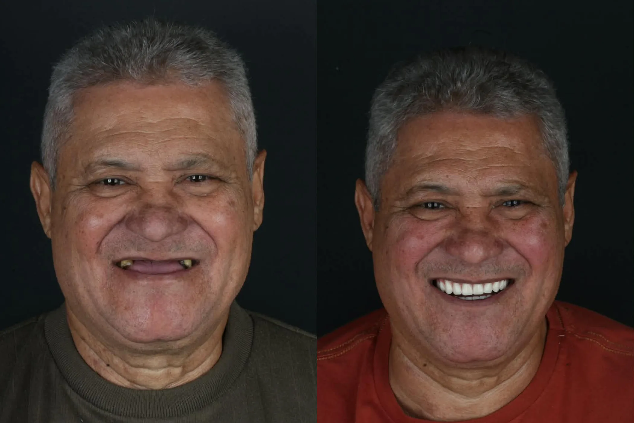Antes e depois de implantes dentários na Oral Renove