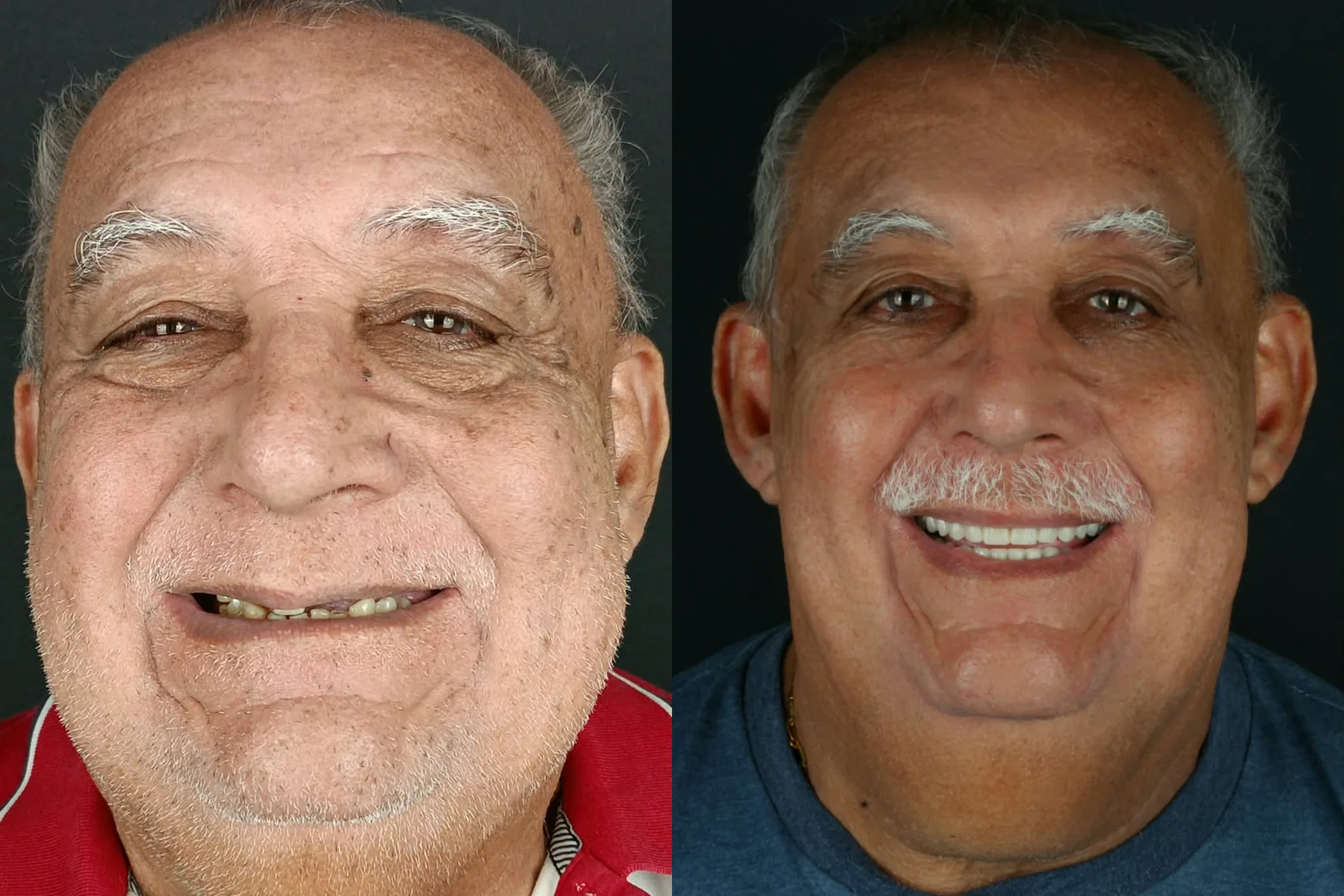 Antes e depois de implantes dentários na Oral Renove