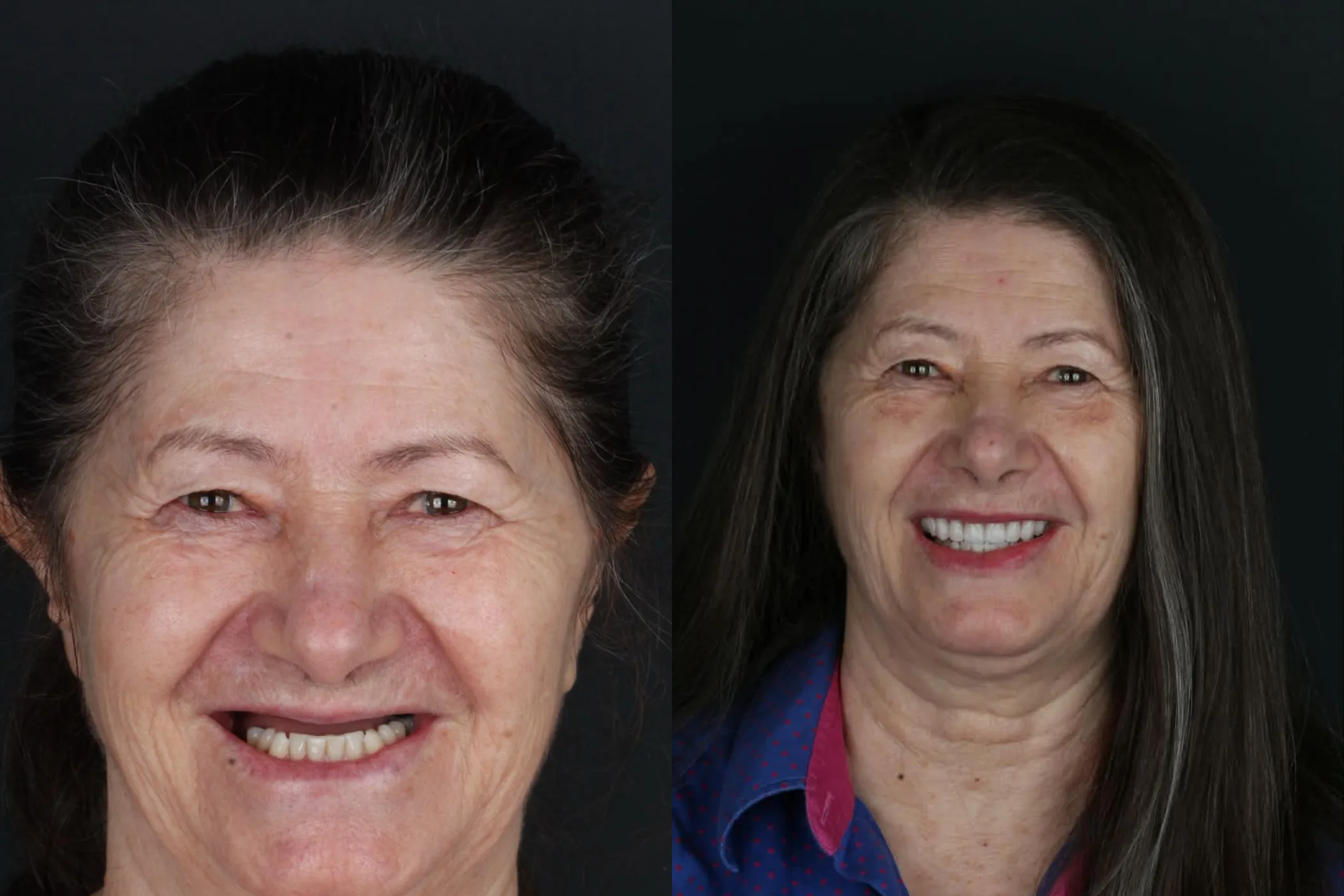 Antes e depois de implantes dentários na Oral Renove