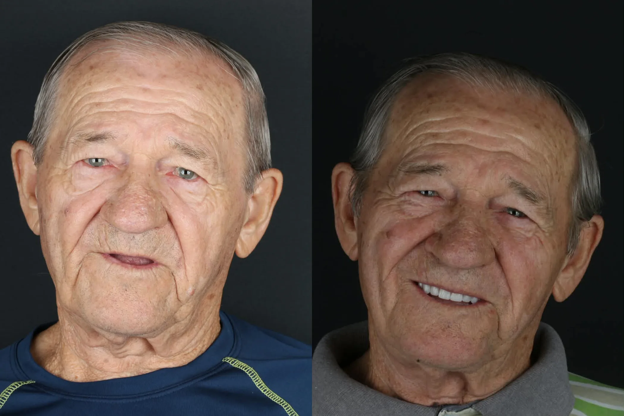 Antes e depois de implantes dentários na Oral Renove
