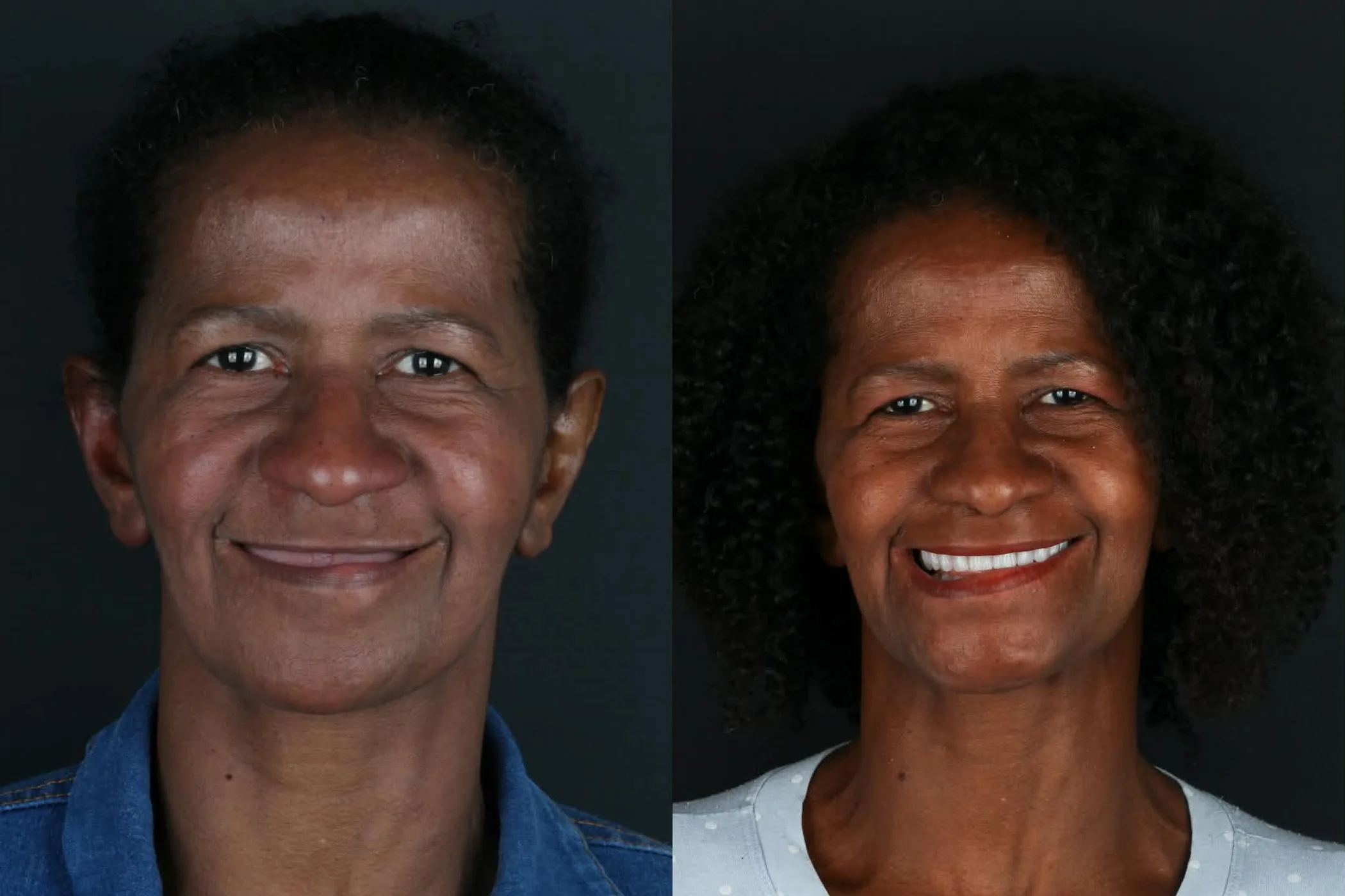 Antes e depois de implantes dentários na Oral Renove