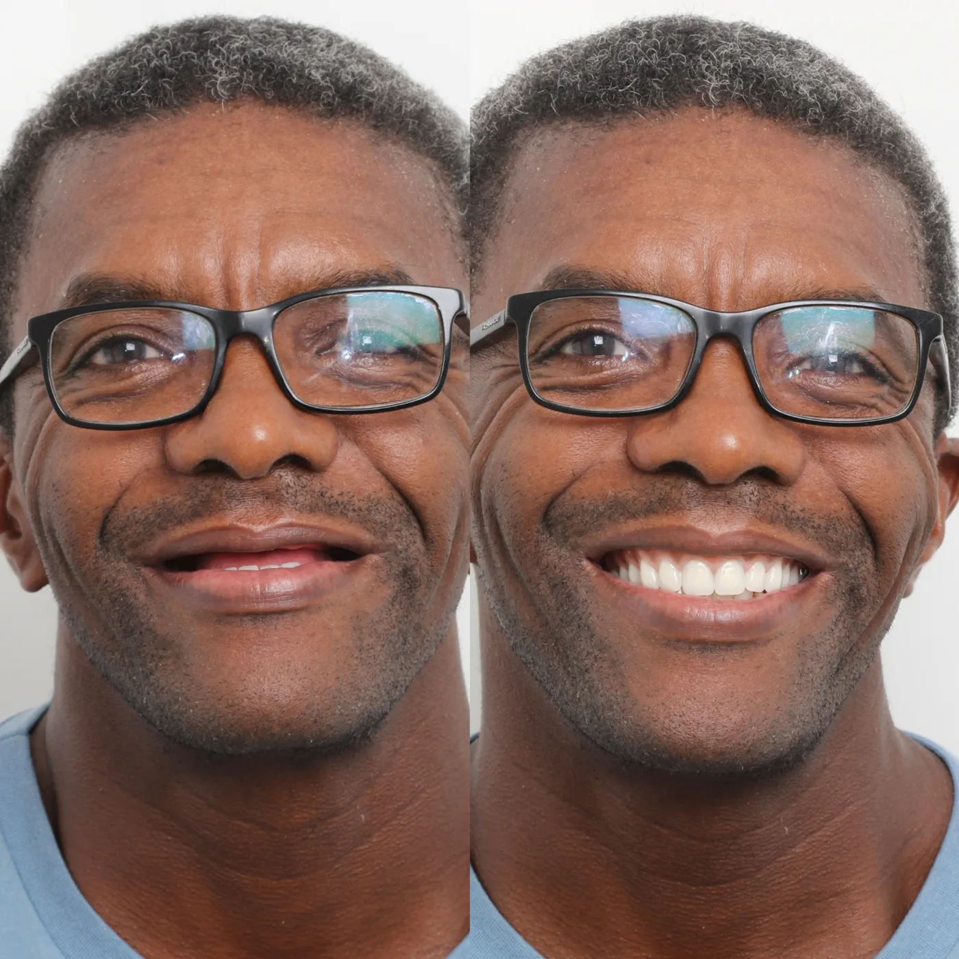 Antes e depois — implante unitário