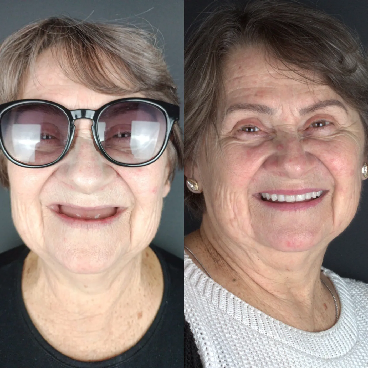 Antes e depois — prótese total fixa